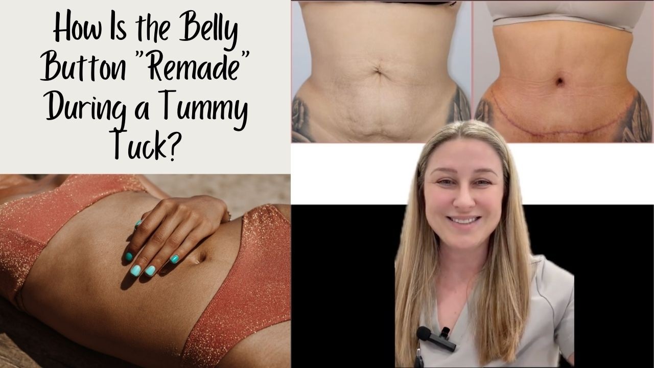 What Happens to the Belly Button During a Tummy Tuck?