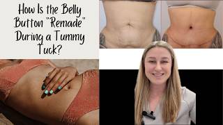 What Happens to the Belly Button During a Tummy Tuck?