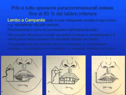 Ricostruzione labbro inferiore chirurgia plastica pancia piatta