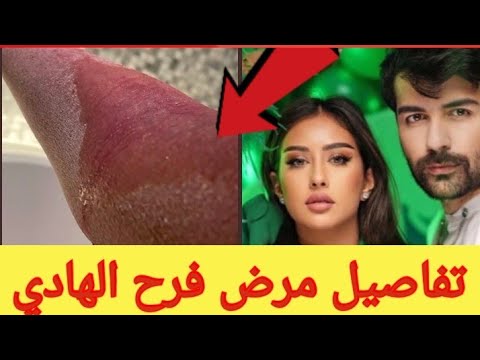 عقيل الرئيسي يتهم والدة زوجته فرح الهادي بالسحر مرض فرح الهادي