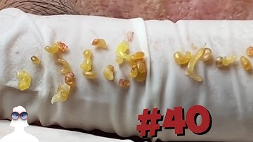 This Week in PIMPLE  POPPING #40