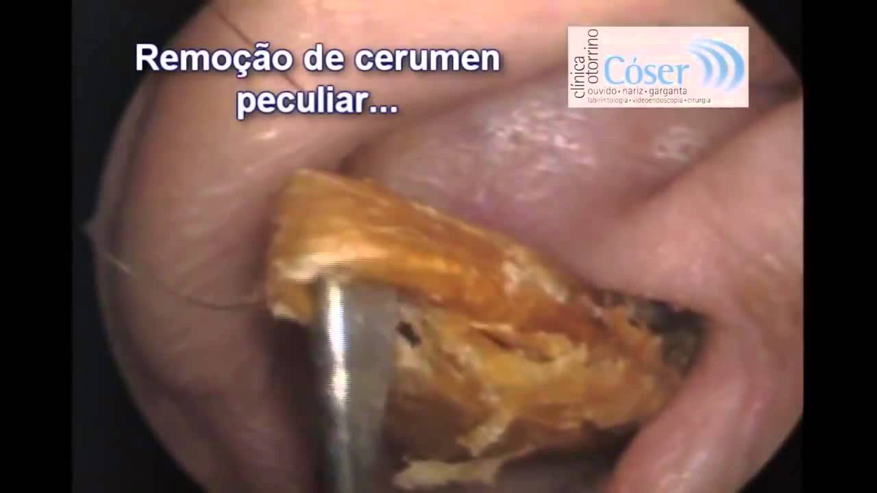 Play Ear Wax Removal Videos 70