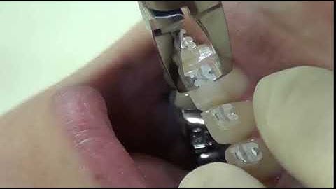 Debonding di GC Experience Ceramic