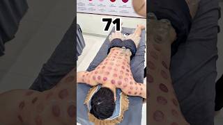 [ASMR] 使用160个罐子的全身拔罐疗法 #asmr #cuppingtherapy #massage
