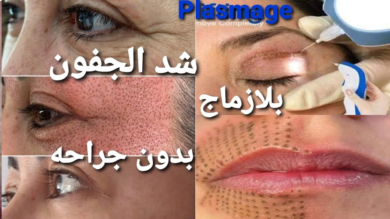شد الجفون /الأنف بدون جراحه تقنية #البلازماج لأزالة تجاعيد الوجه والخطوط التعبيريه  #Plasmage
