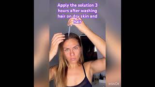 #hair DHT-blocker #cashapp #coffee#castoroil#ketoconazole #minoxidil#haircare