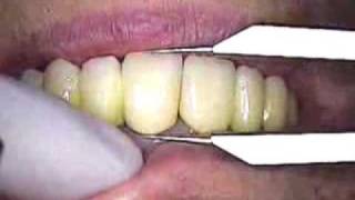 DR. GERARD CUOMO -Dental Implants Ken's Case Bisque Tryin Cosmetic Dentistry  Boca Raton, Florida 17