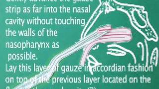 Anterior Nasal Packing