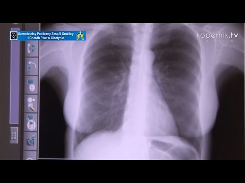 Wideo: Wysięk Parapneumoniczny: Rodzaje, Objawy, Przyczyny I Leczenie