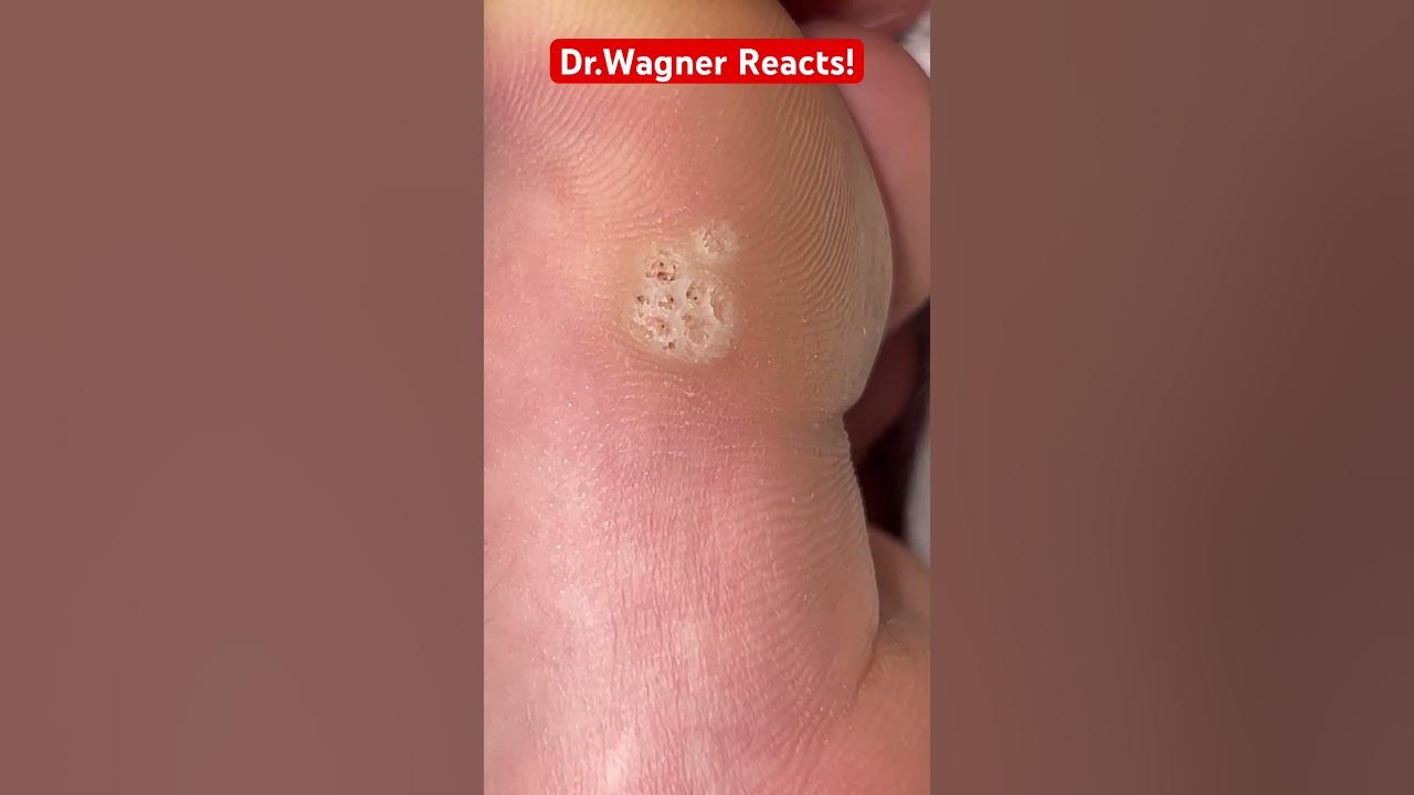 BEETLE JUICE TREATMENT FOR WARTS🐸shorts YouTube