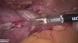 Total laparoscopic hysterectomy with bilateral salpingectomy in case of previous cesarean section.