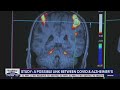 Study: A possible link between COVID and Alzheimer