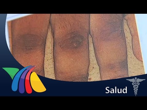 Video: ¿Deberían los dedos de los pies tener nudillos?