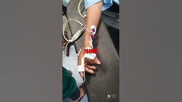 neuromuscular monitoring