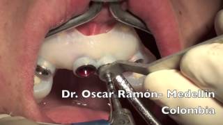 Dr. Oscar Miguel Ramón Morales #клинический случай #имплантация зубов(University of Antioquia (Medellín-Colombia). Сложный хирургический случай по имплантации зубов с использованием хирургическо..., 2016-04-26T14:31:37.000Z)