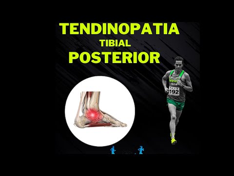 Vídeo: A fisioterapia ajuda a tendinite tibial posterior?