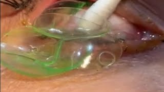 Doctor removes 23 contact lenses from patient's eye screenshot 5