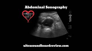 Abdominal Aortic Aneurysm