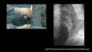 Videos: GORE TAG Conformable Thoracic Stent Graft with ACTIVE ...