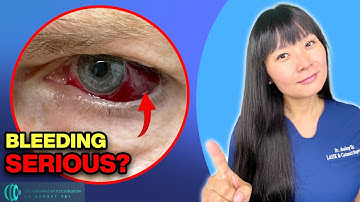 Bleeding in the Eye | Subconjunctival Hemorrhage | Everything You Need to Know |Eye Surgeon Explains