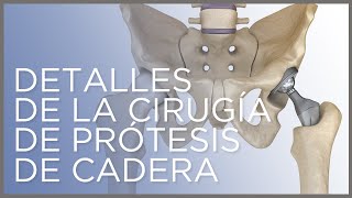 Detalles de la cirugía de prótesis de cadera, Dr. Ángel Villamor