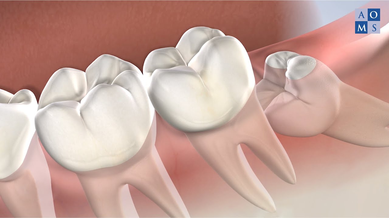 Dental Filling Pre-Operative Instructions