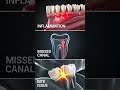 Why Does My Tooth Hurt Even After a Root Canal? #dentalcare #smiledesigndental #dentalclinic
