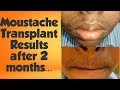 Moustache transplant  first 3 months update  shedding to growth phase  drsreenath  kochi