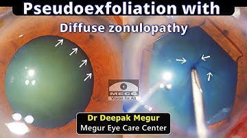 Phacoemulsification in an eye with Diffuse Zonulopathy secondary to Pseudoexfoliation- Dr Megur