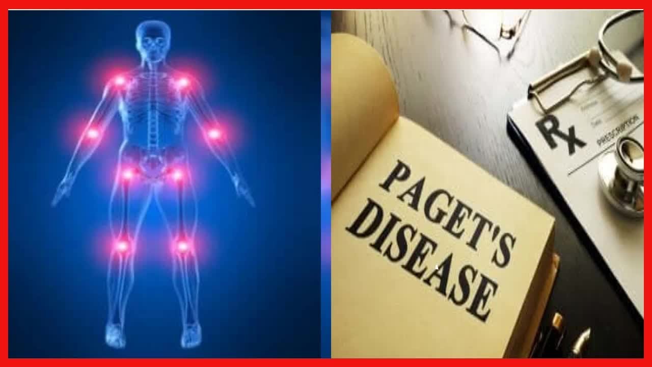 Morbus Paget: Erkrankung der Knochen - YouTube