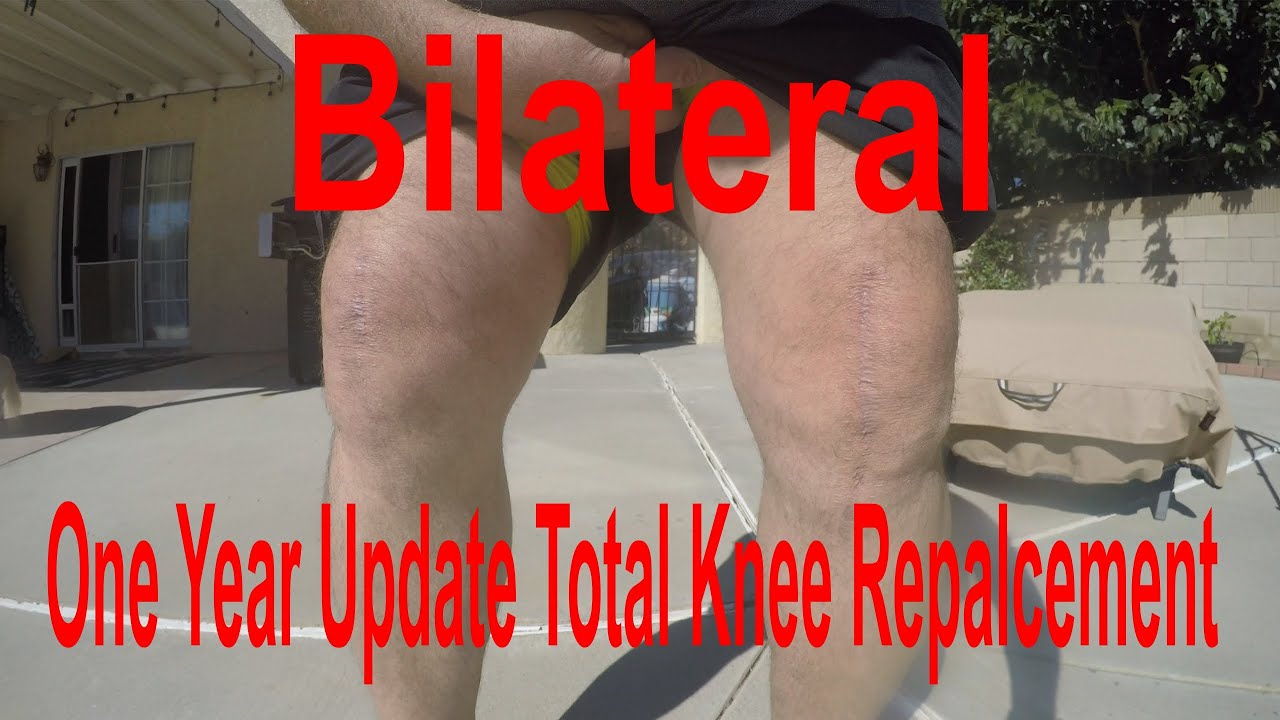 Bilateral Total Knee Replacement One Year Update BTKR Pain Mikey Mike's