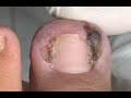 Seriously ingrown nail