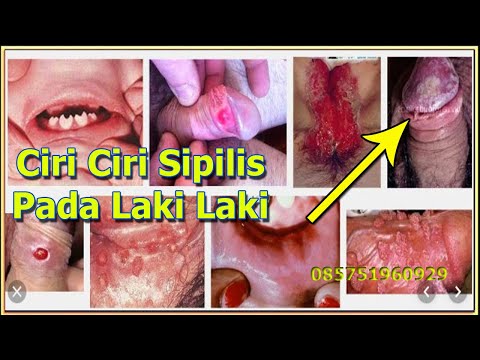ciri-ciri-penyakit-sipilis-pada-laki-laki