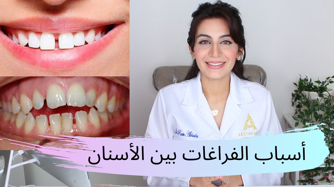 أسباب الفراغات بين الأسنان
