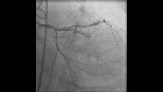 LMS PCI in a patient with graft failure
