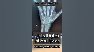 نهاية الطول وعمر العظام د خالد الجناعي 