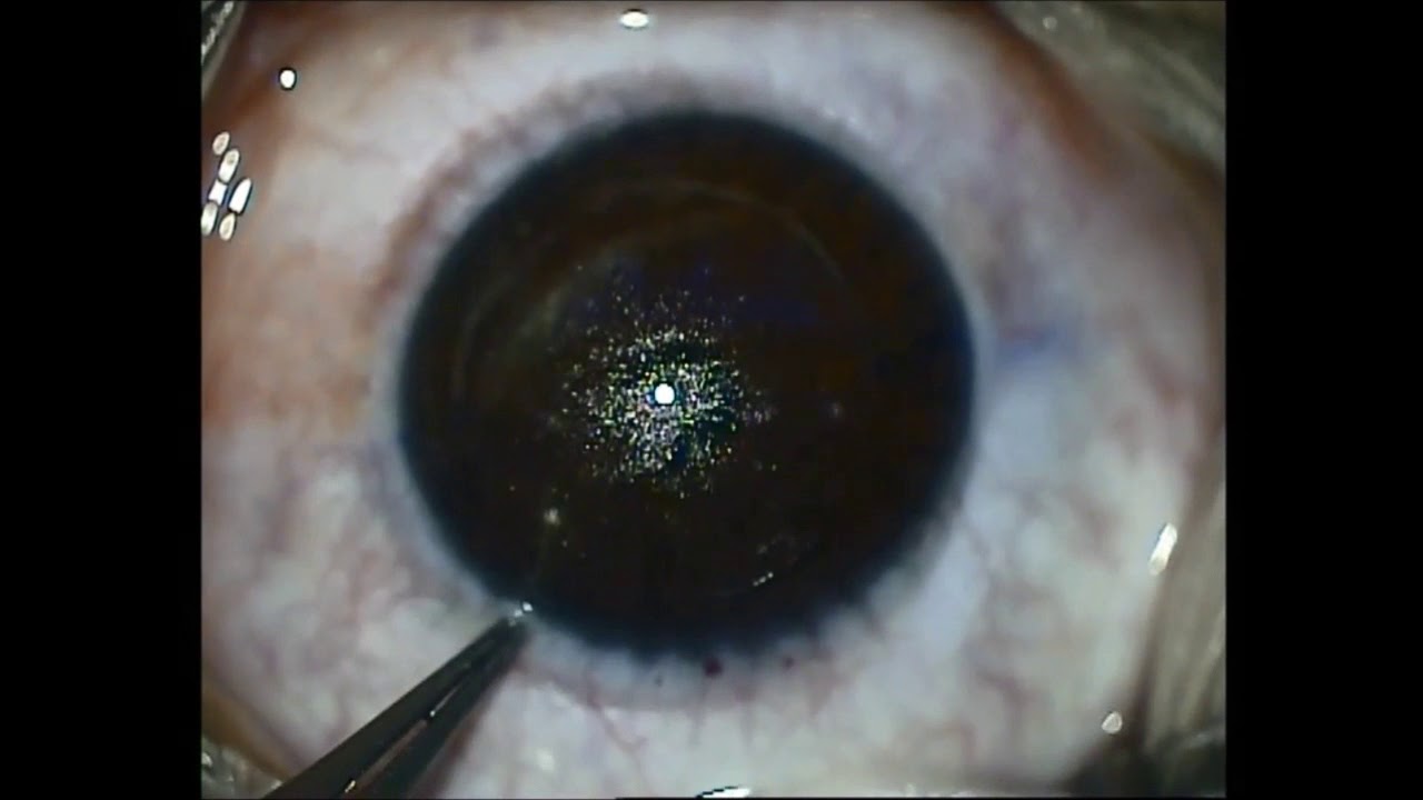 ReLEx SMILE (Small Incision Lenticule Extraction) - YouTube