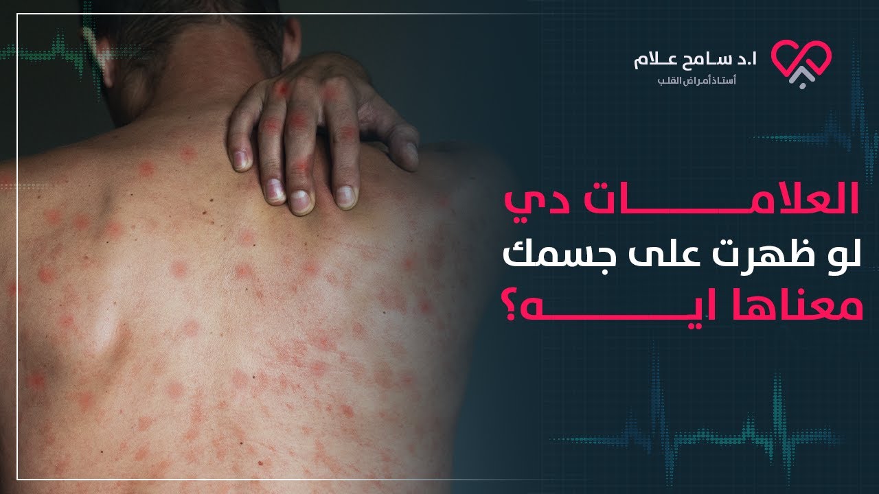 نقص الصفائح الدموية وارتفاعها وتأثيرها على القلب وباقي الجسم | سامح علام