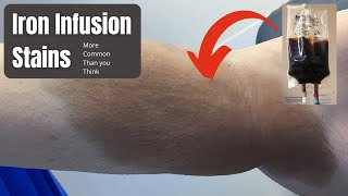 Iron Infusion Stains How To Treat? Dermatologist Explains