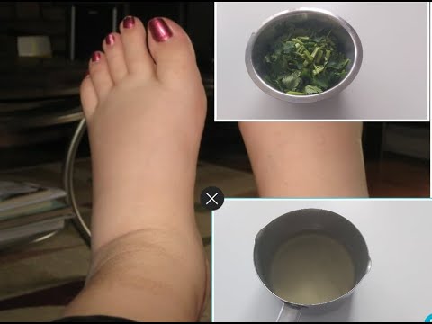 Video: Otekle Noge Zaradi Sladkorne Bolezni: Vzroki, Zdravljenje In Nasveti O življenjskem Slogu