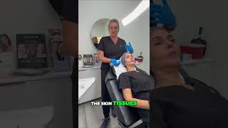 Non-Surgical Facelift: Thread Lifting for a Subtle Lift! #shorts
