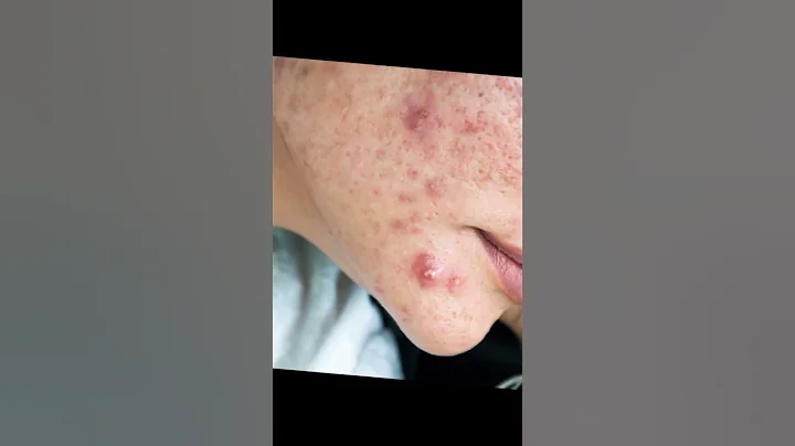 The Truth About Toothpaste for Acne (Safe Alternatives!)