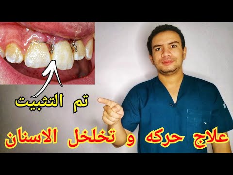 فيديو: كيفية التخلص من الأسنان المترهلة: 11 خطوة (بالصور)