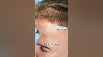 How Scalp Expansion Works 🤔