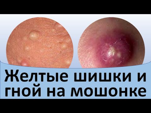 Желтые шишки и гной на мошонке