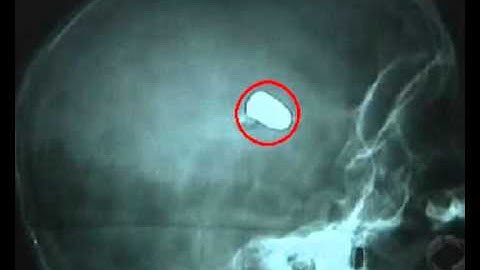 Active contours - xray