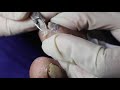 Ep_3016 Toenail removal 👣 โห..มันปักอยู่ในเนื้อ 😷 (This clip is from Thailand)