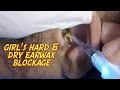 Girl's Hard & Dry Earwax Blockage Removal