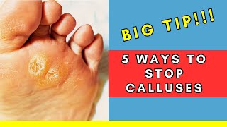 Celebrity STOP Calluses: 5 Steps to Prevent Them from Returning (Podiatrist Tips!) | BONUS clinic strategy Profile