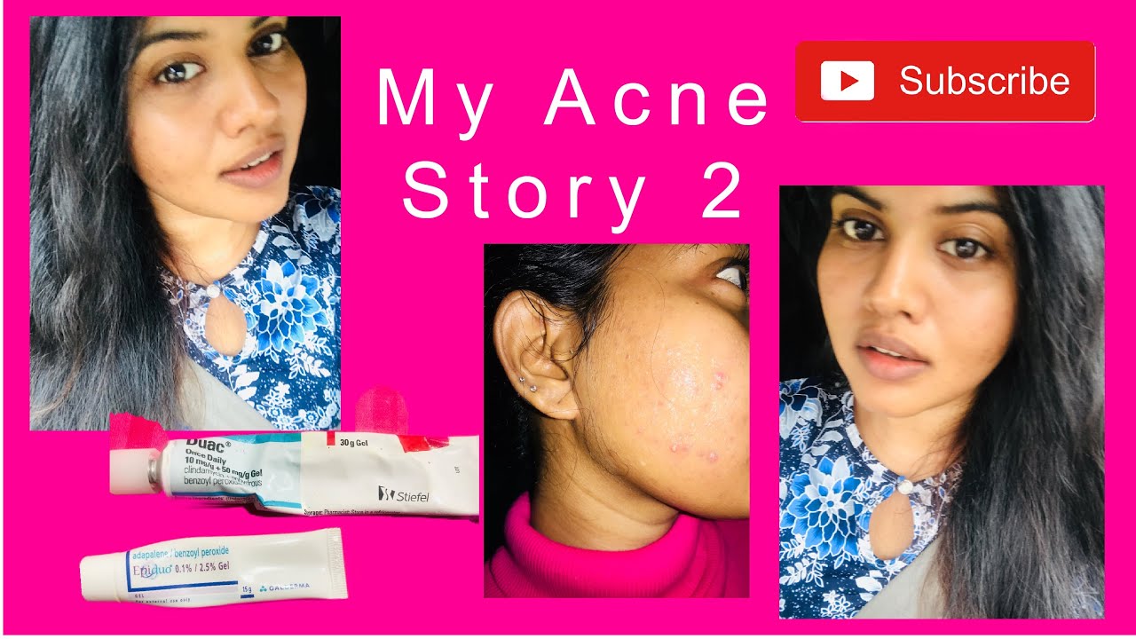 My Acne Story | Part 2 : how I got rid of Acne - YouTube